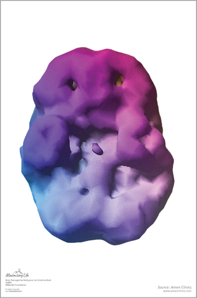 Scan of Brain Damaged by Marijuana Use (Underside)